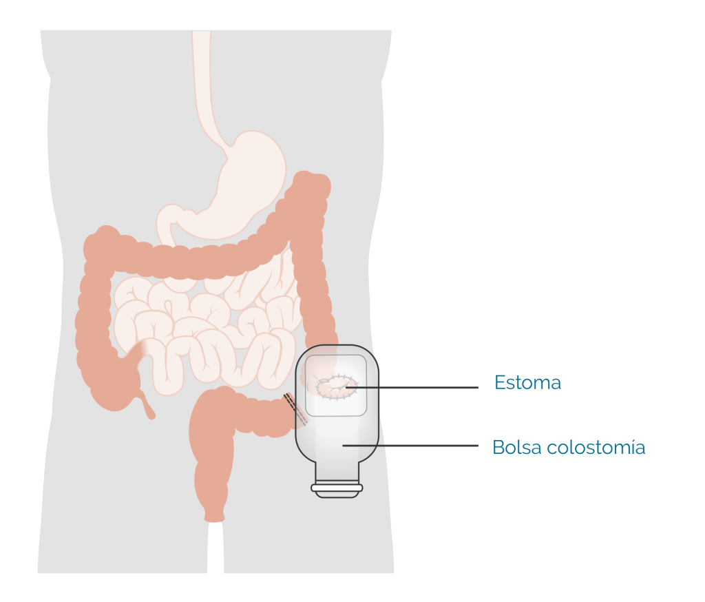 Colostomia con bolsa colocada